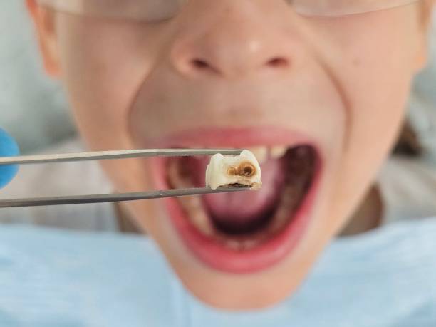 Best Emergency Wisdom Teeth Removal in North Port, FL